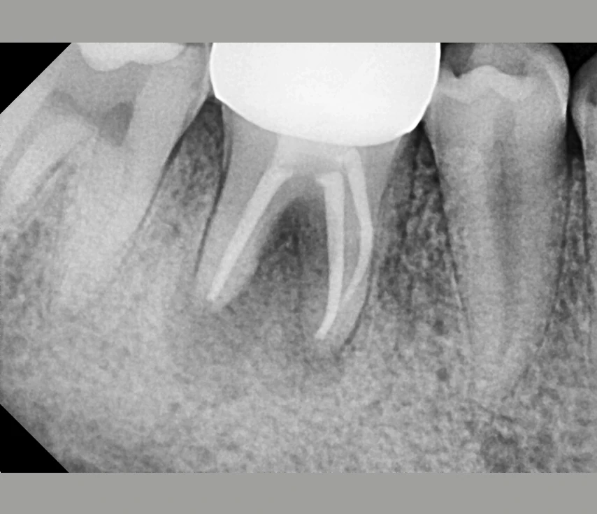 Lakshmi Smiles dental treatment case image